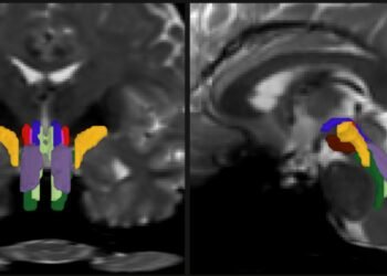 AI algorithm enables tracking of vital white matter pathways | MIT News